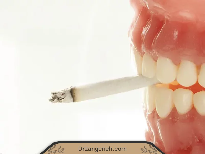 تاقیر سیگار بر لمینت دندان