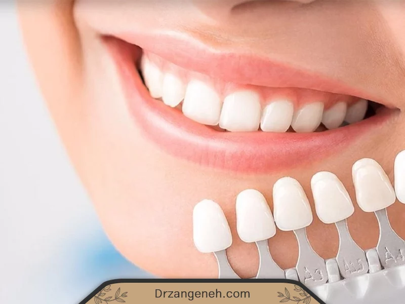 عمر لمینت دندان چقدر است؟