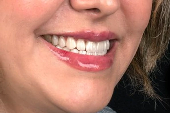 نمونه کامپوزیت 4