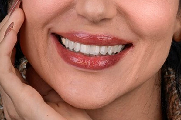 نمونه کامپوزیت 2