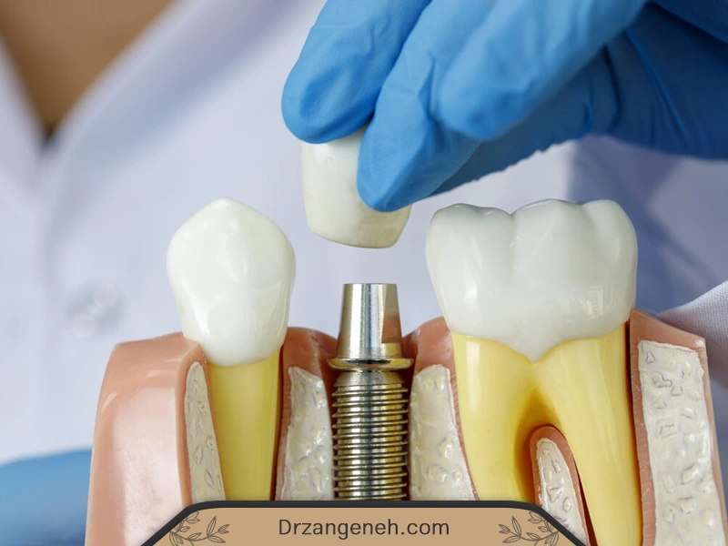 ایمپلنت دندان