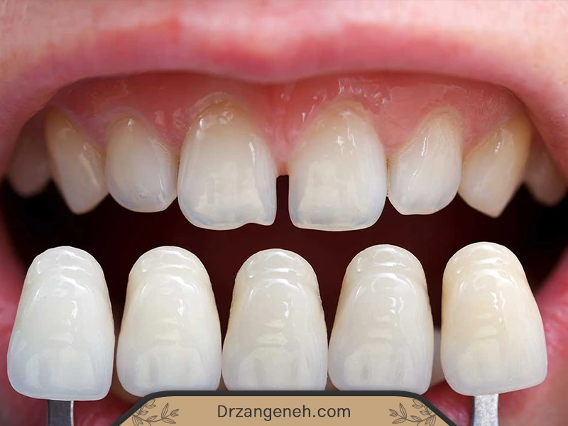 لمینت سرامیکی