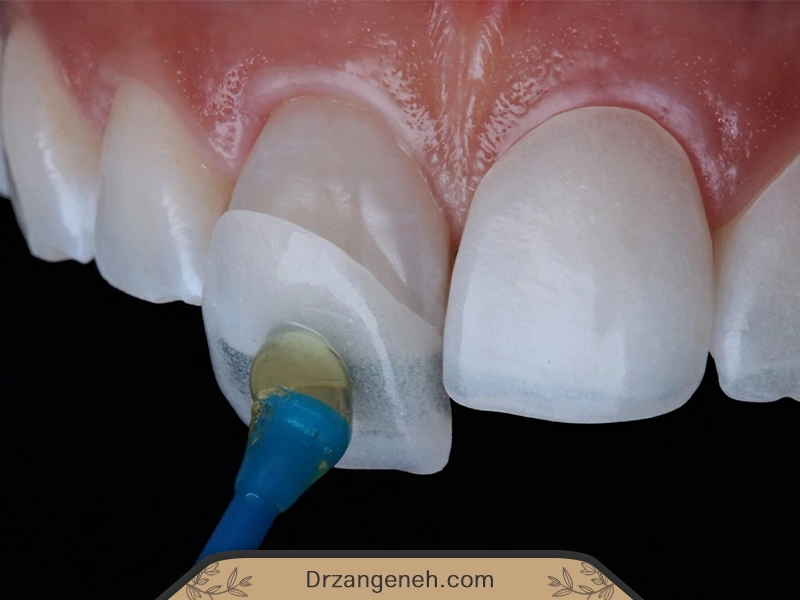 کامپوزیت ونیر